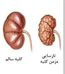 پاورپوینت نارسایی مزمن کلیه