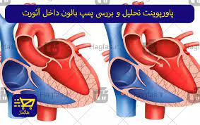 پاورپوینت آشنایی با بالن پمپ داخل آئورت و نحوه کار آن (ppt) 38 اسلاید