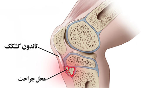 دانلود پاورپوینت معرفی بیماری ازگود اشلاتر